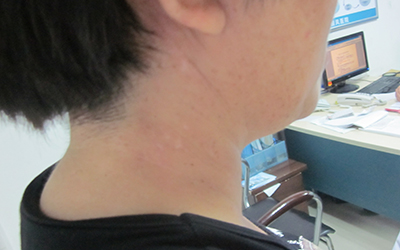308激光治疗仪多少钱