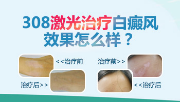 照白癜风的308准分子激光怎么买