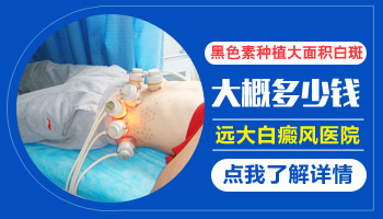 黑色素种植治疗白癜风怎么样