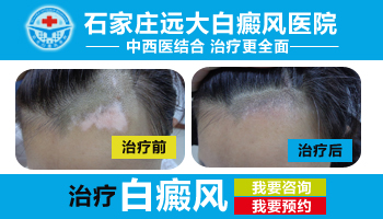 儿童白癜风患者的治疗要点