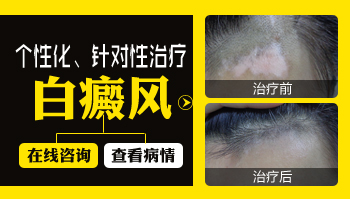 石家庄白癜风治疗