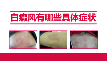 白癜风白斑会传染给其它人吗