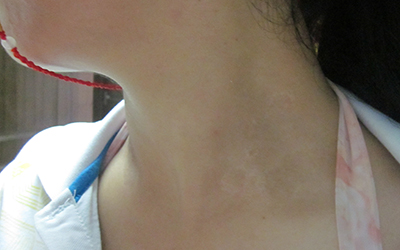 患白癜风和饮食有关系吗