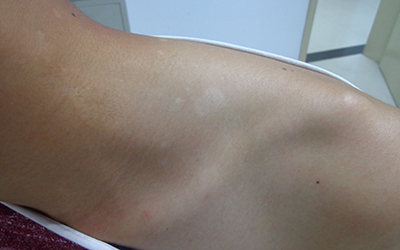 手上有白斑怎么办