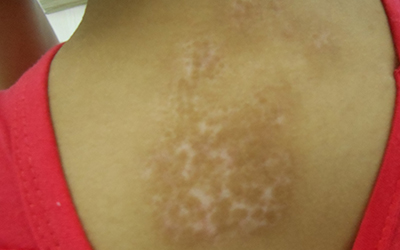 儿童白癜风有好的治疗方法吗