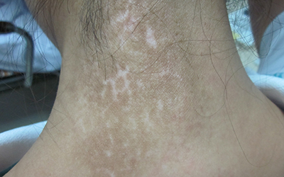 背部白癜风白斑治疗起来困难吗