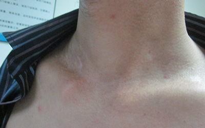 青少年治疗白癜风要怎么做