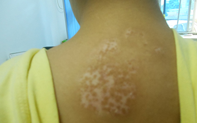 脸上长白癜风白斑能治疗好吗