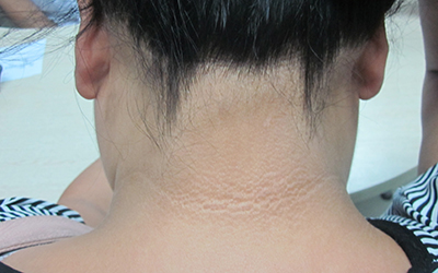 青少年白癜风发作的原因有哪些呢