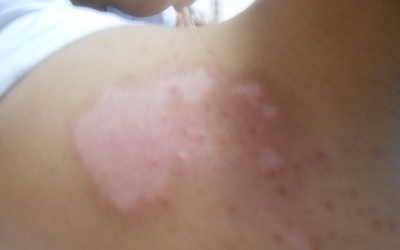 头上有白斑怎么治