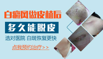 石家庄哪里可以治疗腿上的一些白癜风