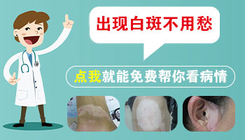 白癜风在脸上适合哪种方法见效快无危害
