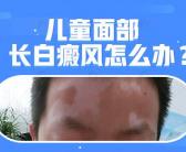 目前治疗白癜风怎么治好