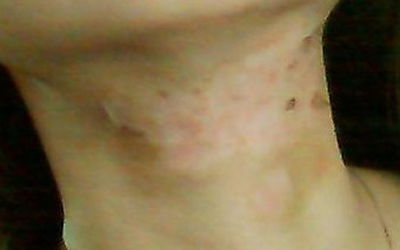 脖子上的白癜风白斑怎么治疗好得快