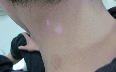 后背长了好多白斑点怎么办