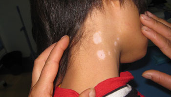 白癜风白斑这病能治好吗