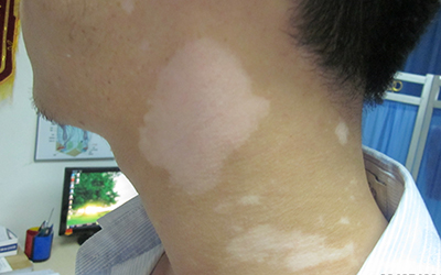 白癜风白斑怎么治