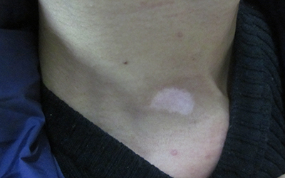 治疗白癜风白斑怎么做好