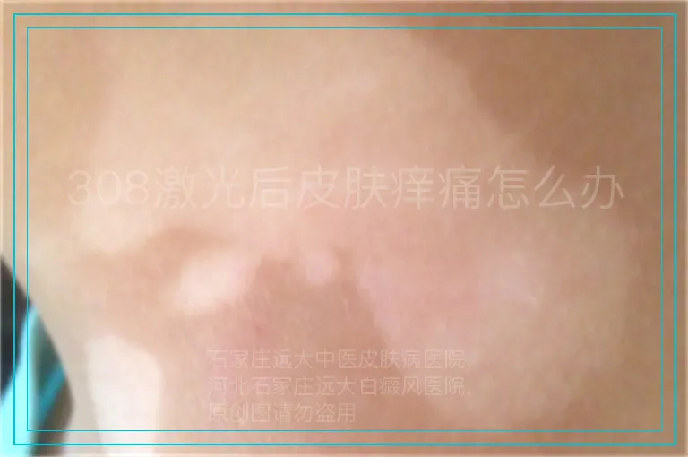308激光后皮肤痒痛怎么办