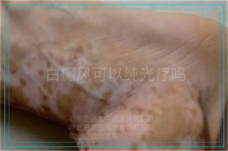 白癜风可以纯光疗吗