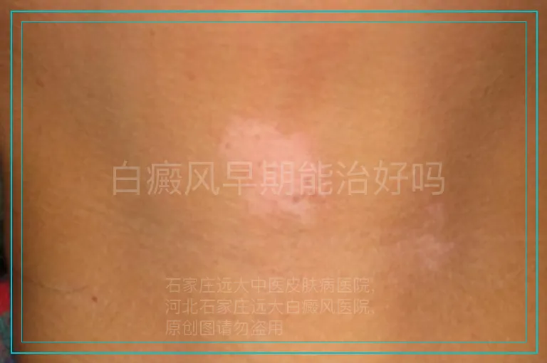 白癜风早期能治好吗
