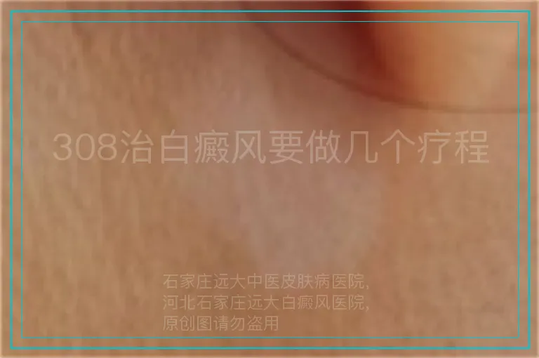 308治白癜风要做几个疗程