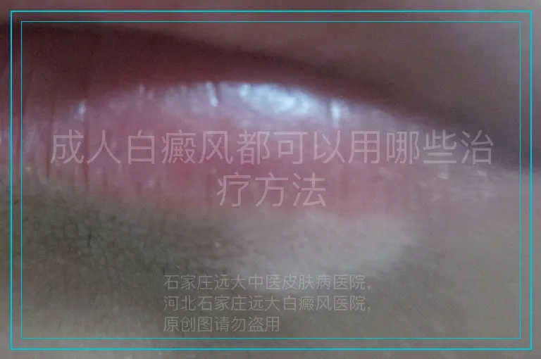 成人白癜风都可以用哪些治疗方法