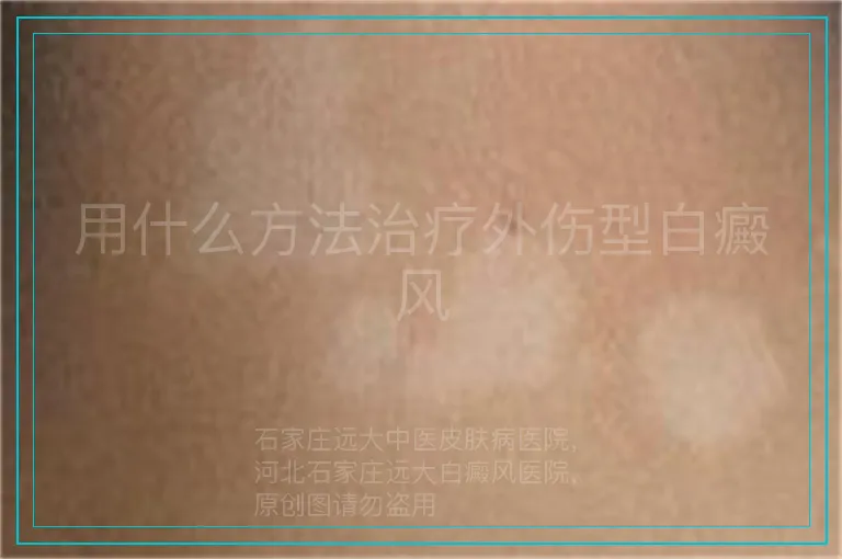 用什么方法治疗外伤型白癜风