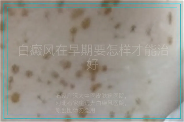 白癜风在早期要怎样才能治好