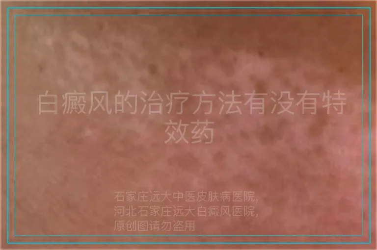 白癜风的治疗方法有没有特效药