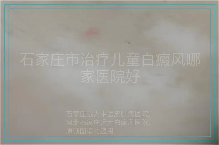 石家庄市治疗儿童白癜风哪家医院好