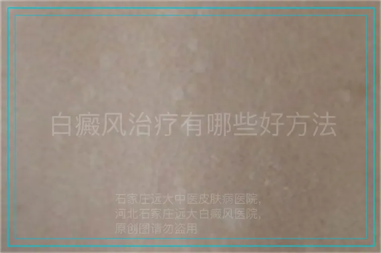 白癜风治疗有哪些好方法