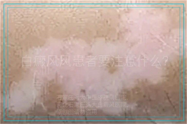 白癜风风患者要注意什么?