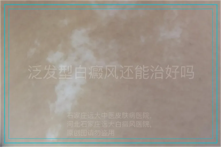 泛发型白癜风还能治好吗