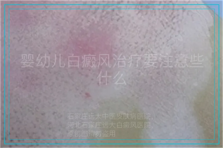 婴幼儿白癜风治疗要注意些什么