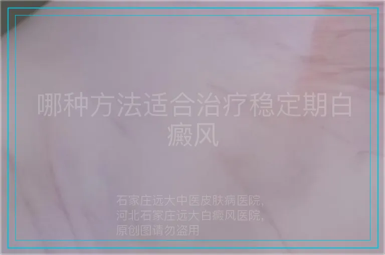 哪种方法适合治疗稳定期白癜风