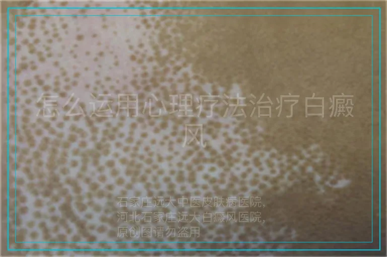 怎么运用心理疗法治疗白癜风