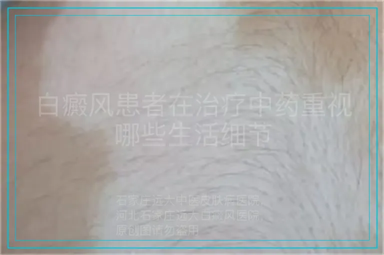 白癜风患者在治疗中药重视哪些生活细节