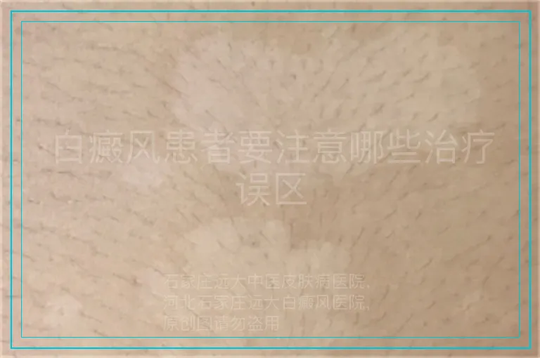 白癜风患者要注意哪些治疗误区