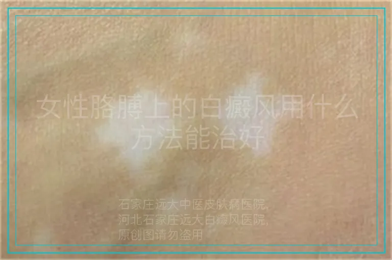 女性胳膊上的白癜风用什么方法能治好