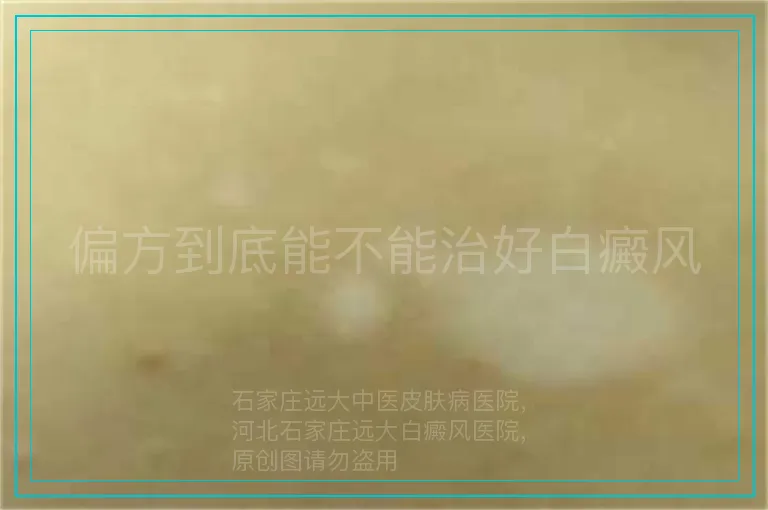 偏方到底能不能治好白癜风