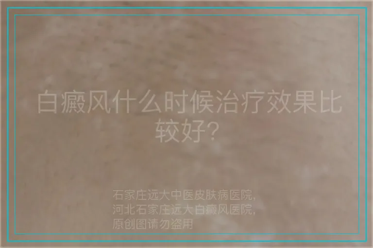白癜风什么时候治疗效果比较好?