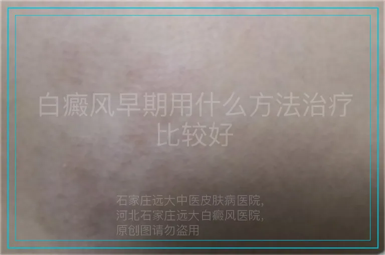 白癜风早期用什么方法治疗比较好