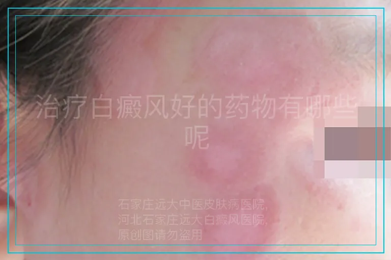 治疗白癜风好的药物有哪些呢