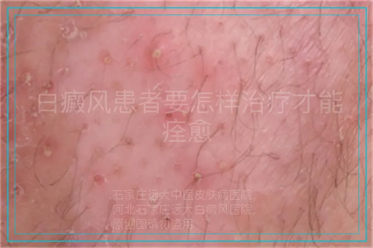 白癜风患者要怎样治疗才能痊愈