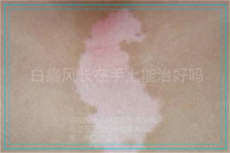 白癜风长在手上能治好吗