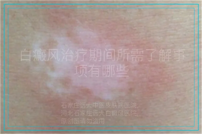 白癜风治疗期间所需了解事项有哪些