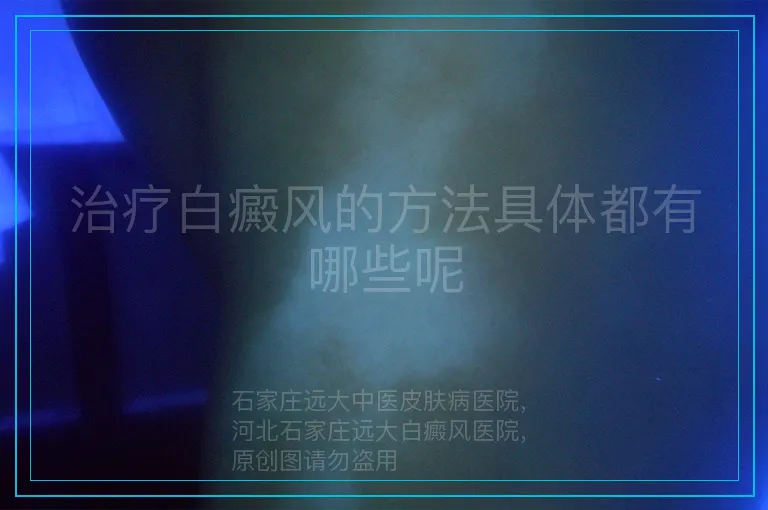 治疗白癜风的方法具体都有哪些呢