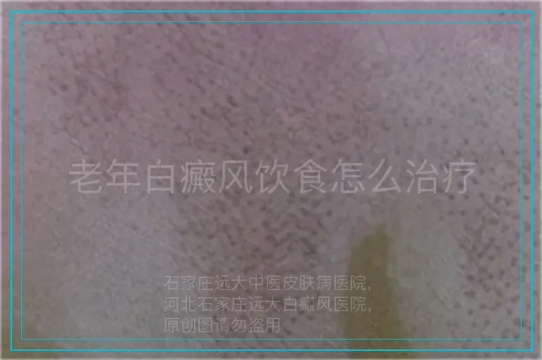 老年白癜风饮食怎么治疗