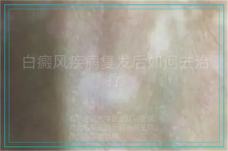 白癜风疾病复发后如何去治疗